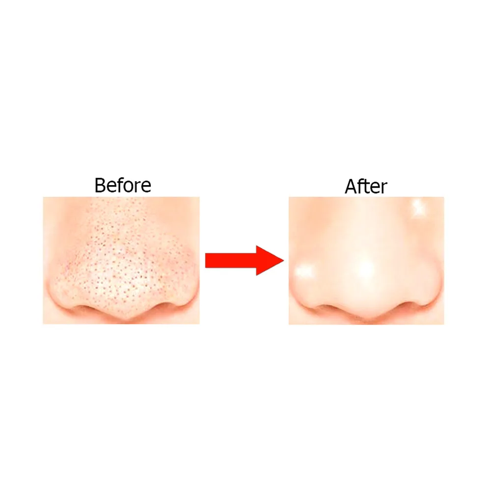 9pc Nu-Pore Nose Cleansing Strips Blackhead Remover Peel Off Mask Nose Whitehead